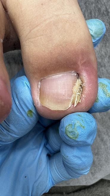 педикюр для мужчин: Коррекция вросших ногтей, Педикюр, Услуги подолога, Консультация — 3