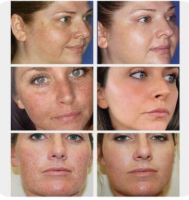 эффективный отбеливающий крем для зоны бикини в аптеке: ❄️ США Крем интенсивное отбеливание с Аmazon и Еbay Крем дает ▶ — 18