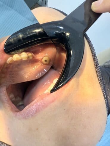 реставрация 4 зуба: Врачи | Стоматолог | Диагностика — 5