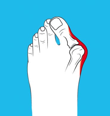 фиксатор пальца: Лечение косточки, вальгусной деформации большого пальца ноги — 1