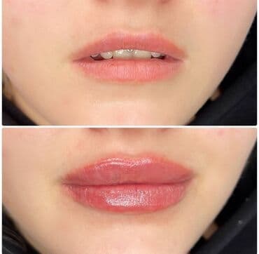 Косметология, Ботулинотерапия, Маски, Удаление гусинных лапок, Гипоаллергенные материалы, Консультация, Сертифицированный косметолог