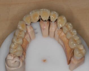 обучение медсестры: Обучение зубных техников металлокерамика восковое моделирование — 4