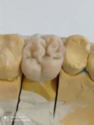 обучение медсестры: Обучение зубных техников металлокерамика восковое моделирование — 1