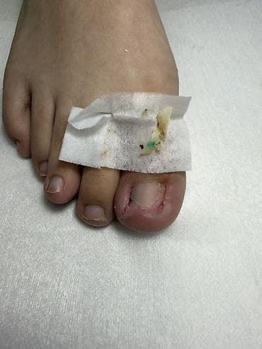 удаление папилом: Коррекция вросших ногтей, Педикюр, Одноразовые расходные материалы — 8