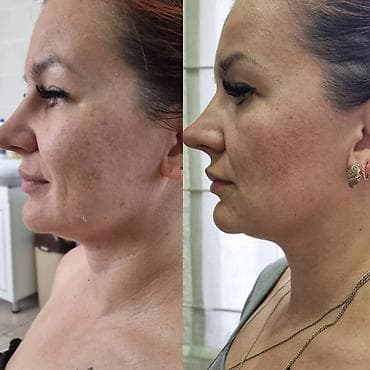 мезотерапия лица: Косметология, Контурное моделирование, Лифтинг, Массаж лица, Консультация, Гипоаллергенные материалы — 10