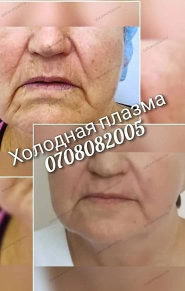 купероз лечение бишкек: Косметология, Ботокс, Биоревитализация, Ботулинотерапия, Консультация, Гипоаллергенные материалы, Сертифицированный косметолог — 1