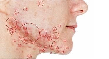 кожный дерматолог: Косметология, Лечение угревой болезни, Консультация — 1