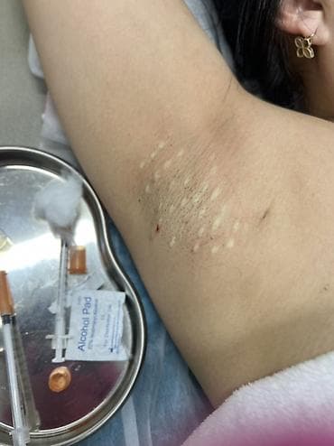 a 72: Гипергидроз деген эмне? Гипергидроз — бул нормадан тышкары коп тердо — 1