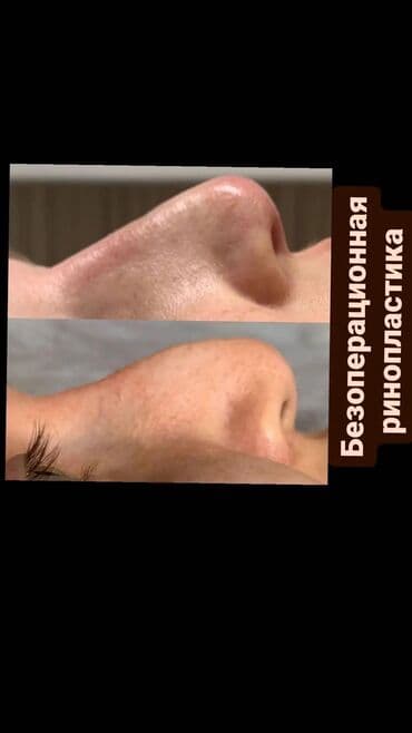 нейлоновые зубные протезы в бишкеке цены: Косметология, Ботокс, Биоревитализация, Ботулинотерапия, Консультация, Гипоаллергенные материалы, Сертифицированный косметолог — 5