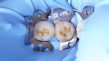 услуги стоматологии: Стоматолог Бишкек. Профессиональная чистка. Лечение кариеса и его — 6