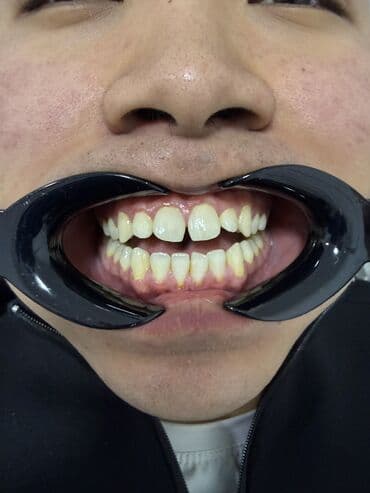 реставрация 4 зуба: Врачи | Стоматолог | Диагностика — 2