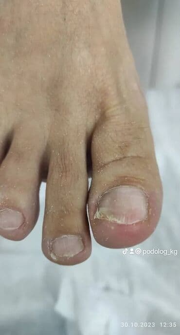 маникюр педикюр с выездом на дом: Коррекция вросших ногтей, Выравнивание, Услуги подолога, Маникюр, Педикюр, С выездом на дом, Консультация, Одноразовые расходные материалы — 8