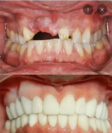 сколько стоит поставить брекеты на зубы: Врачи | Стоматолог | Протезирование, Другие медицинские услуги — 3