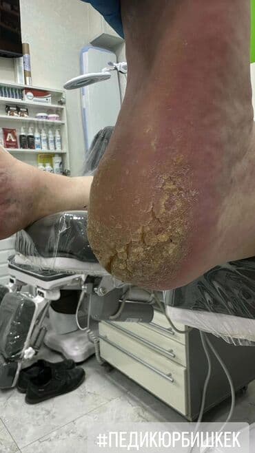 Ичине кирип өскөн тырмактарды оңдоо, Маникюр, Педикюр, Подолог кызматтары, Консультация, Бир жолку сарпталуучу материалдар lalafo.kg да Ичине кирип өскөн тырмактарды оңдоо, Маникюр, Педикюр, Подолог кызматтары, Консультация, Бир жолку сарпталуучу материалдар