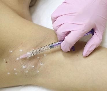 Сулуулук жана ден-соолук: Инъекционная процедура для снижения потоотделения в зоне подмышек — 1