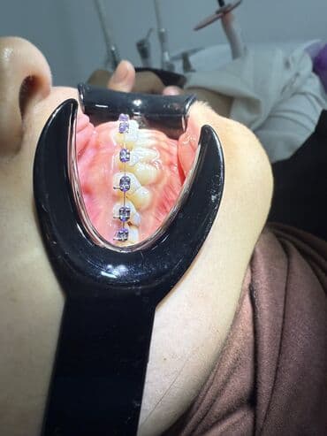 реставрация 4 зуба: Врачи | Стоматолог | Диагностика — 3