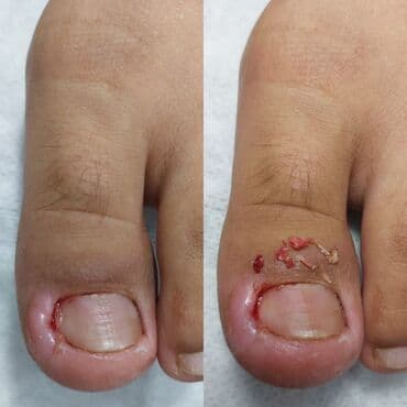 сколько стоит обучение на маникюр: Коррекция вросших ногтей, Услуги подолога, Педикюр, Одноразовые расходные материалы, Консультация — 4