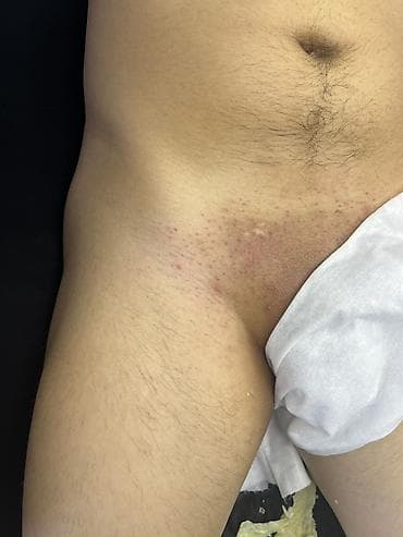 против комаров: Мужская депиляция зоны бикини/пах воском - Услуга: удаление — 1