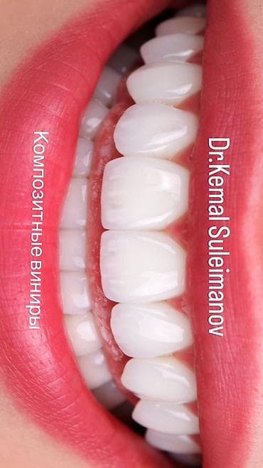 Композитные виниры Услуга эстетической реставрации зубов композитными