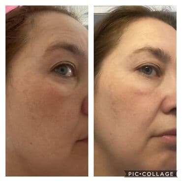 эффективный отбеливающий крем для зоны бикини в аптеке: Expigment Экспигмент Сроки до 2027 Свежая поставка с Турции 🇹🇷 💯% — 13