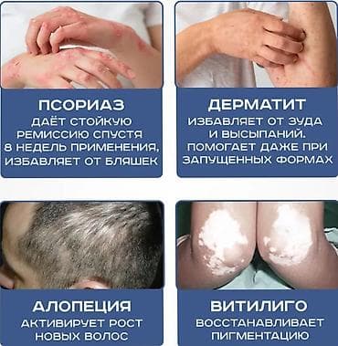Медициналык лампалар: Уф лампа витилиго 311 нм – передовое решение для эффективной домашней — 2