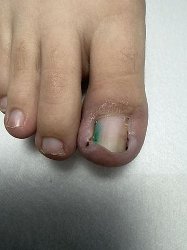 удаление папилом: Коррекция вросших ногтей, Педикюр, Одноразовые расходные материалы — 7