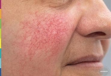 Удаление сосудистых звёздочек и купероза на лице - Аппаратная