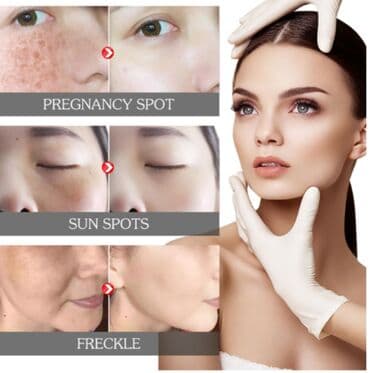 эффективный отбеливающий крем для зоны бикини в аптеке: США Крем отбеливающий для удаления мелазмы осветления кожи удаления — 3