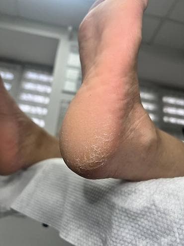 кожный врач: Коррекция вросших ногтей, Педикюр, Одноразовые расходные материалы — 1