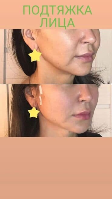 нейлоновые зубные протезы в бишкеке цены: Косметология, Ботокс, Биоревитализация, Ботулинотерапия, Консультация, Гипоаллергенные материалы, Сертифицированный косметолог — 8