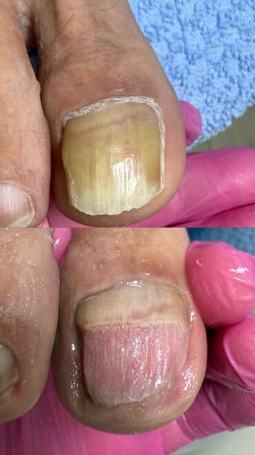 Коррекция вросших ногтей, Услуги подолога, С выездом на дом, Консультация, Одноразовые расходные материалы