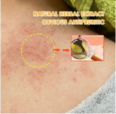 эко спрей от вшей как пользоваться: ❄️ Крем от кожного фолликулита и фолликулита кожи головы Снимает — 5