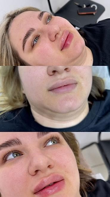 из пластика: Косметология, Увеличение губ, Консультация — 3