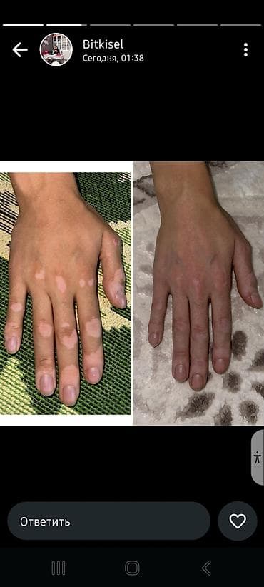 мазь от витилиго: Растительный крем для кожи с гипопигментацией (витилиго) - Формула на — 2