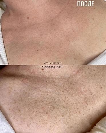 лечебные массаж ош: Лазерная эпиляция. Чистка лица. Лечение акне. Гименопластика — 4