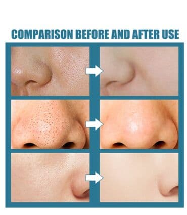 прыщей: ❄️ США СЫВОРОТКА ДЛЯ КОЖИ ОТБЕЛИВАНИЕ цена-450сом\флак-розниц — 4