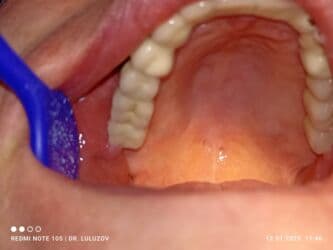 хиджама кровопускание: Клиника | Стоматолог | Протезирование — 5