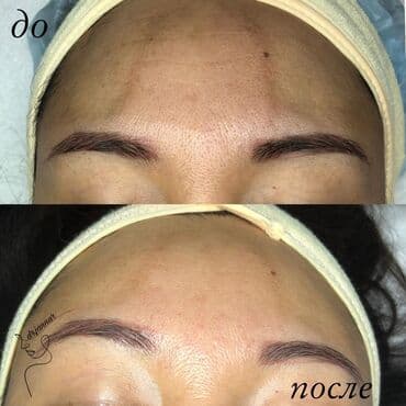 хиджама кровопускание: Косметология, Чистка кожи, Биоревитализация, Пилинг, Сертифицированный косметолог, Гипоаллергенные материалы, Консультация — 5