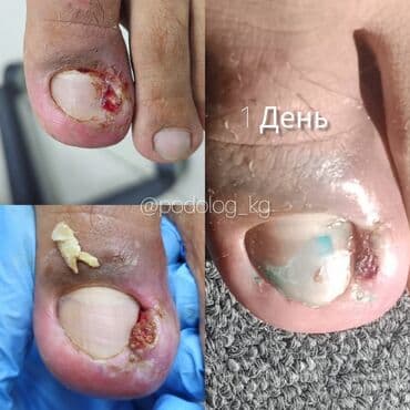 медсестра на дом бишкек мкр: Выравнивание, Наращивание ногтей, Донаращивание ногтей, Маникюр, Педикюр, Услуги подолога, С выездом на дом, Консультация, Одноразовые расходные материалы — 2