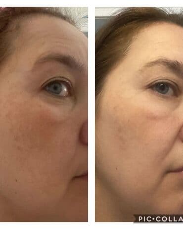 эффективный отбеливающий крем для зоны бикини в аптеке: Expigment Экспигмент Сроки до 2027 Свежая поставка с Турции 🇹🇷 💯% — 9