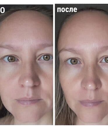 купить ортопедический наколенник: Косметический бандаж для подтяжки лица, подбородка предназначен — 5