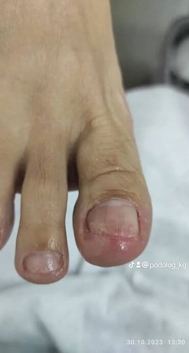 маникюр педикюр с выездом на дом: Коррекция вросших ногтей, Выравнивание, Услуги подолога, Маникюр, Педикюр, С выездом на дом, Консультация, Одноразовые расходные материалы — 9