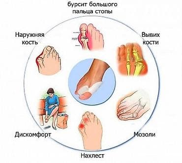 Корректоры для большого пальца ноги от вальгусной деформации(косточки