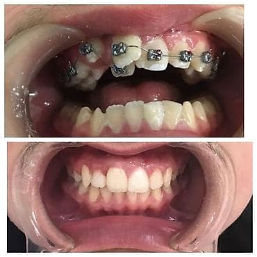 брекеты цена бишкек 2020: К вашему вниманию предоставляется услуга по установке брекет-системы — 4