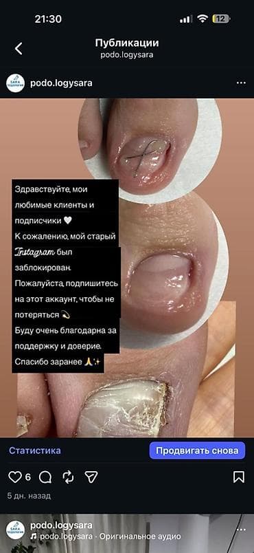 Предлагается профессиональная услуга по лечению вросшего ногтя