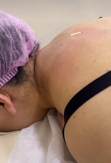 Тату, пирсинг: --Саламатсызбы 💎 ЭЭК АСТЫ ЖАНА ХОЛКА ЛИПОСАКЦИЯСЫ *Ээк асты – — 3