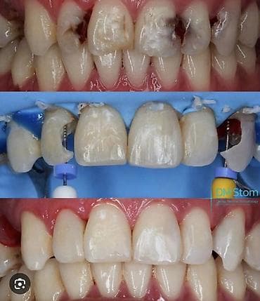 Реставрация передних зубов - Эстетическая и функциональная at lalafo.kg Реставрация передних зубов - Эстетическая и функциональная