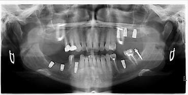 prm 20c: Gendex GP-300 Ортопантомограф (Оптг) Производство Финляндия Страна — 4