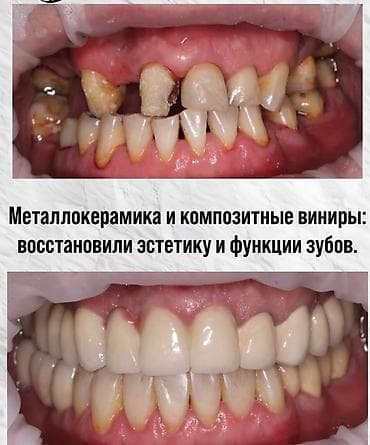 лечения: Стоматологические услуги - Лечение кариеса: японская пломба — 1500 — 9