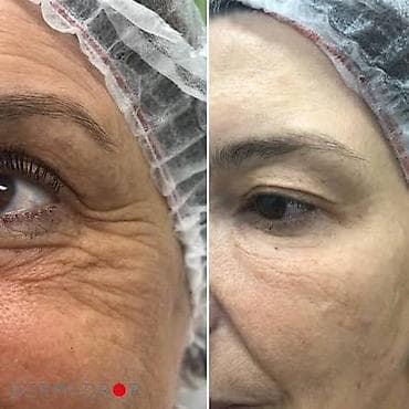 процедура: ✨ Нужны модели на увлажняющую мезотерапию! ✨ Хотите свежую — 3